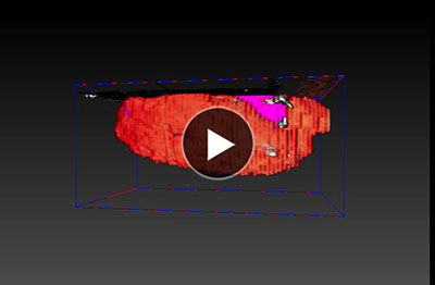 [3D image] 3D image of abnormalities (Orange: Cavity area; Pink: inclusions) Cavity volume: 7.5 μm3